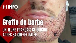 Un Français de 24 ans se suicide après une greffe de barbe ratée