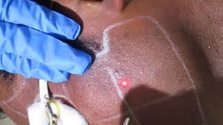 Skin Whitening Treatment in Delhi By Q-Switched Laser at Delhi Laser Clinic