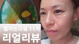 멜라논크림 사용11일차 리얼리뷰(#검버섯치료제#기미잡티#점제거)