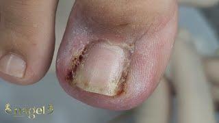 O ÁPICE DO TRATAMENTO PODOLÓGICO (ABLAÇÃO) #satisfying #nails
