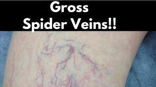 Spider Veins Are Gross but Also a Danger Sign of Poor Cardiovascular Health! What to Do to Reverse!