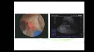 Thulium laser prostate surgery with ultrasound guidance (180cc) Dr. Farid Gadimaliyev
