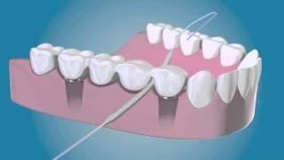 Bridge And Implant Floss by TePe