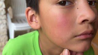 ‘Slapped cheek’ rash is identifying characteristic of fifth disease in children