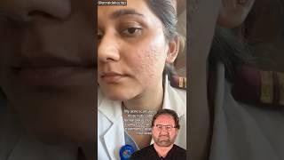 CO2 Laser for Acne Scars - Surgeon Reacts