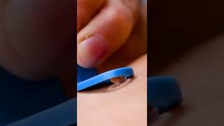 Dermatologist reacts to viral at home skin tag remover. #shorts