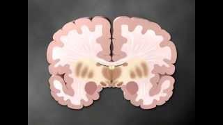 Parkinson's part 1 of 2 - Medical Animation by Watermark