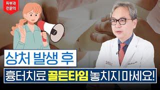 흉터예방에도 '골든타임'이 있다!? 상처가 났다면 이시기 전에는 무조건 치료 받으셔야 합니다! #흉터치료