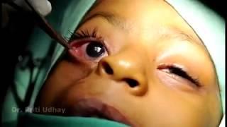 Orbital Cysts in Craniofacial Cleft Patients | DRR Eye Care and Oculoplasty Hospital