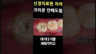 신경치료한 치아 크라운 안해도 됨. 신경치료크라운 하지말고 기둥레진 하면 충분 2023_05_13