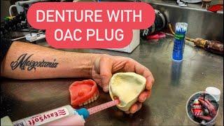 MAKING DENTURE WITH OAC PLUG (OROANTRAL COMMUNICATION) #WAXBAE #DENTURES #OAC