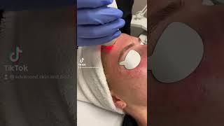 Clear & Brilliant Laser (Skin)