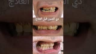 تركيبات زيركون تجميلية للأسنان الاماميه لعلاج اسنان متهالكة