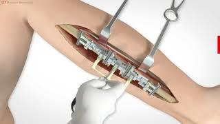 L1® Mandible ReconGuide (English)