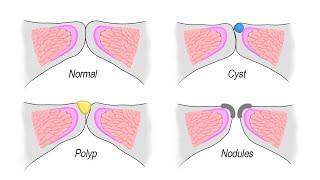 Vocal Fold Vibration (Normal, Nodules, Cyst, Polyp, Muscle Tension Dysphonia, Bowed/Paralysis)