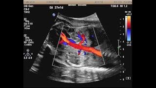 Fetus 27 weeks, Multicystic dysplastic kidney (MCDK), loạn sản đa nang thận trái
