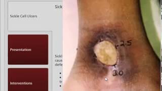 Sickle Cell Ulcers | Sickle Cell Disease | WoundEducators.com