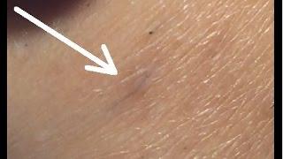 Electrolysis on Ingrown Hairs: Step by Step