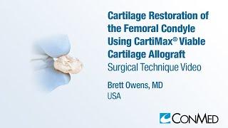 Dr. Brett Owens - Cartilage Restoration of the Femoral Condyle Using CartiMax® - CONMED Technique