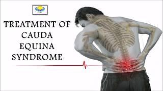 TREATMENT OF CAUDA EQUINA SYNDROME