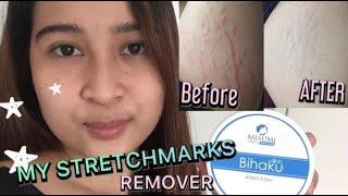 TREATMENT FOR MY STRETCHMARKS BY MARY JANE PORMENTO