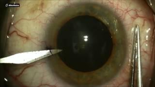 Phacoemulsification: Construction of a Side Port Wound