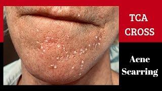 Dr. Weiner's technique for addressing TCA Cross for Acne Scarring