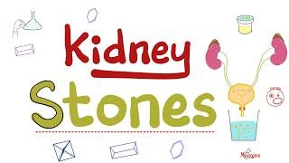 Kidney Stones & Urine crystals (Crystalluria)