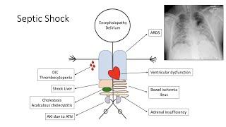 Septic Shock