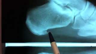 Heel Spur & Plantar Fasciitis Surgery | Heel Pain Treatments