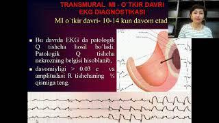 Miokard infarkti    ma`ruzasi              ass Shodiyeva G R