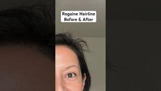 Rogaine Foam Hairline Before And After ‍️ Minoxidil For Women