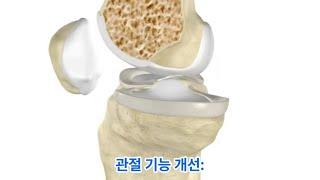 무릎 관절염 : PRP로 회복의 길을 찾다 Knee Arthritis: Finding Recovery through PRP