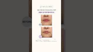 주름 걱정없는 하루! 맑을아 입가전체 콜라겐주사!