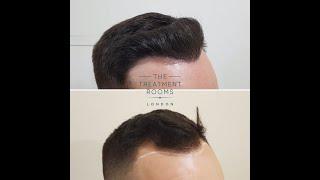 Hair Transplant in London- Results- Before & After 1292 Grafts