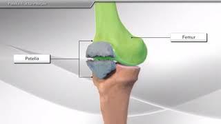 Перелом надколенника: операция