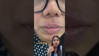 Lip licker’s dermatitis treatment | #liplickersdermatitis #liplicking #shorts #youtubeshorts