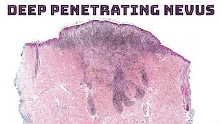 Deep penetrating nevus/melanocytoma - dark black mole beta catenin wnt signaling pathway pathology