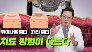 흉터 여드름흉터 비후성반흔 봉합흉터 튀어나오고 패인 흉터 치료 방법