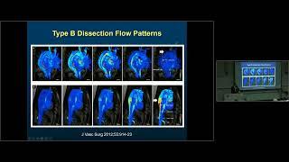 2016 Shumway Lecture: Translational Research in Aortic Disease by John S. Ikonomidis