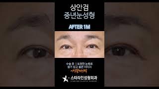 #상안검 Before & After #하안검 #중년눈수술#눈성형 #눈처짐#동안수술 #동안시술 #노화 #안티에이징 #중년#리프팅 #수술전후 #스타라인 #스타라인성형외과 #눈매교정
