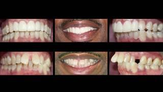 Invisalign and Dental Veneers at Cosmetic Dental Associates San Antonio, TX Dentist Office