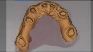 Carestream Dental CS3600 Full arch scan Noritake Porcelain