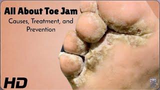 Toe Jam 101: Causes, Fixes, and Prevention!
