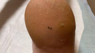 Punch Biopsy of Mystery Heel Spot | Auburn Medical Group