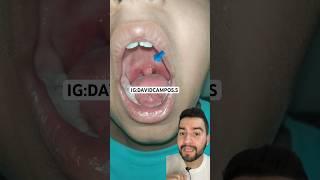 INFLAMACIÓN DE LA CAMPANA / UVULITIS