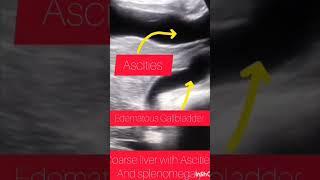 Case of coarse liver |Ascites|splenomegaly|ultrasound