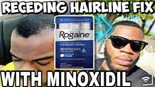 HOW I USED MINOXDIL TO FIX A RECEDING / THINNING HAIRLINE | INSANE RESULTS 