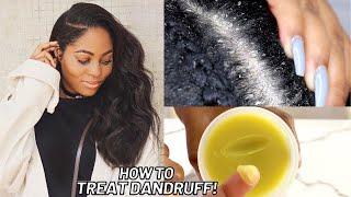 How to Treat Dandruff, Dry Scalp & Psoriasis Naturally at Home‼️