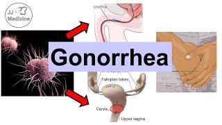 Gonorrhea (Neisseria Gonorrhea) | Pathophysiology, Symptoms & Complications, Diagnosis, Treatment